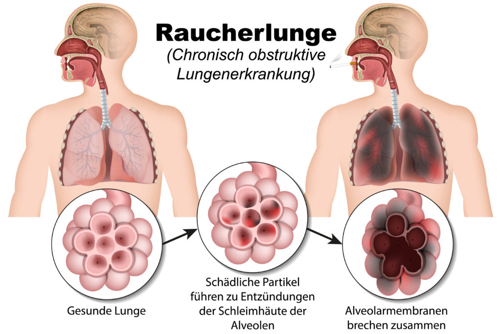 Ein Drittel der chronisch-obstruktiven Lungenkrankheiten betrifft Nichtraucher. (Bild: bilderzwerg/fotolia.com)