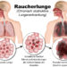 Ein Drittel der chronisch-obstruktiven Lungenkrankheiten betrifft Nichtraucher. (Bild: bilderzwerg/fotolia.com)