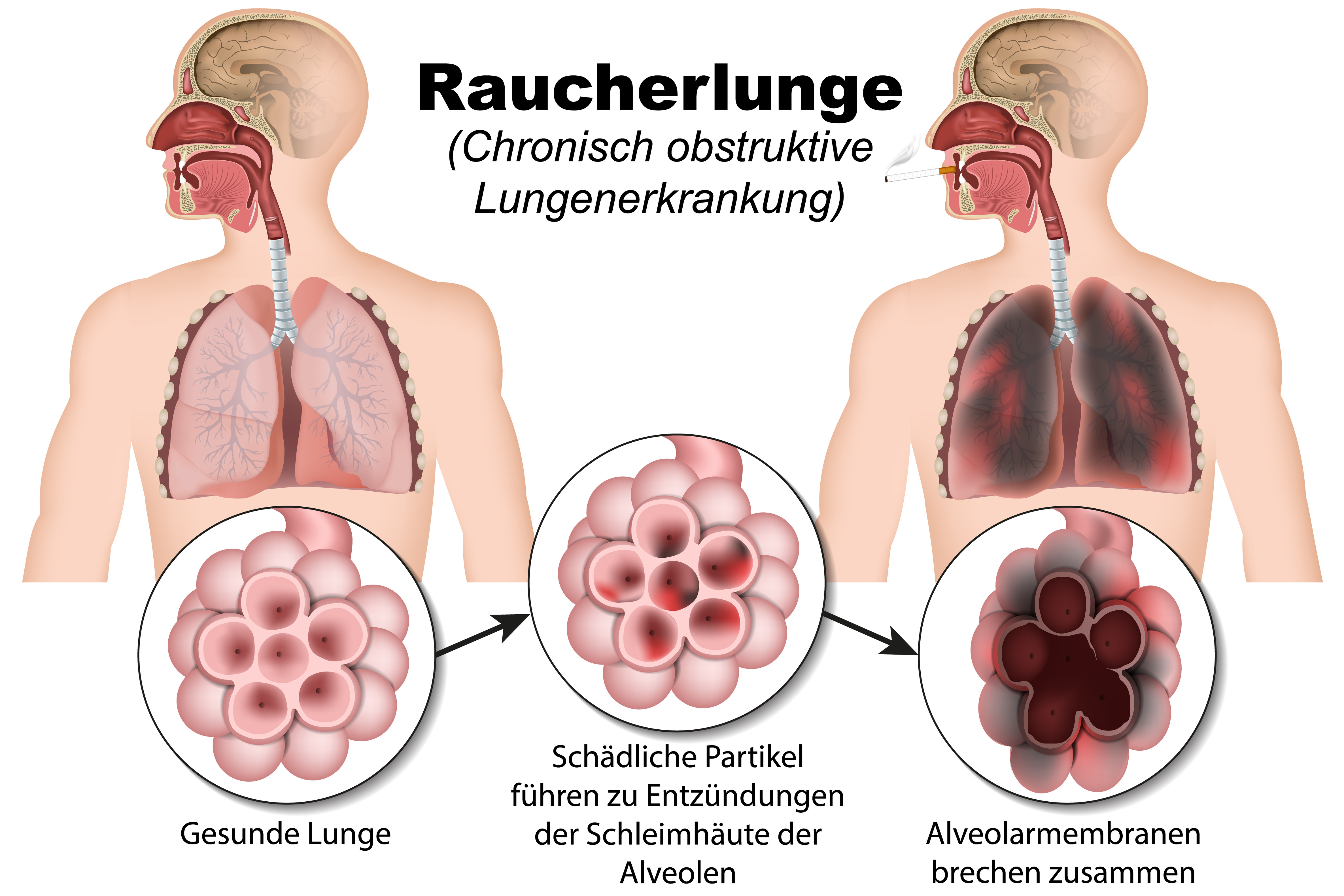 COPD Raucherhusten: Auch Nichtraucher oft betroffen.