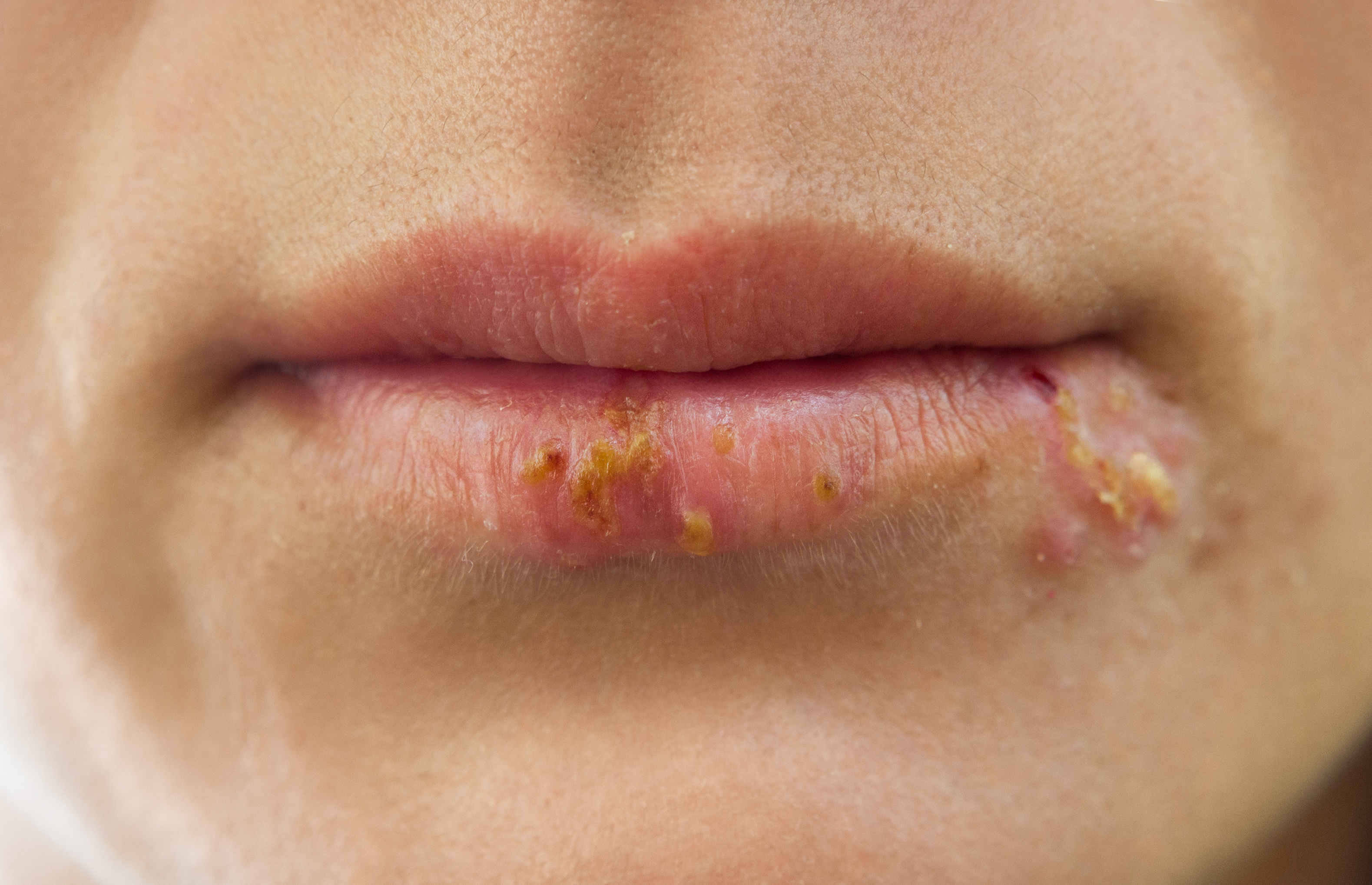 Herpes genitalis wie lange ansteckend