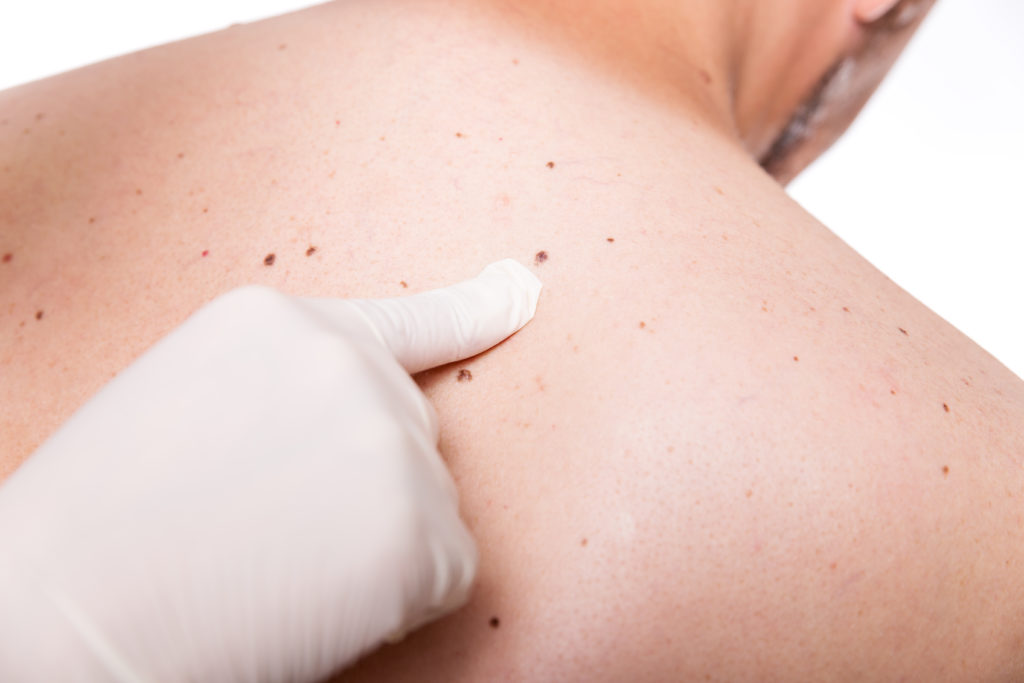 Mit der Größe der Hautoberfläche steigt das Hautkrebs-Risiko. (Bild: Miriam Dörr/fotolia.co)