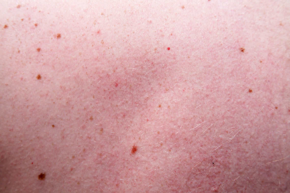 Haut und Leberflecke Alles, was ihr wissen wollt! Mensch Wissen WDR