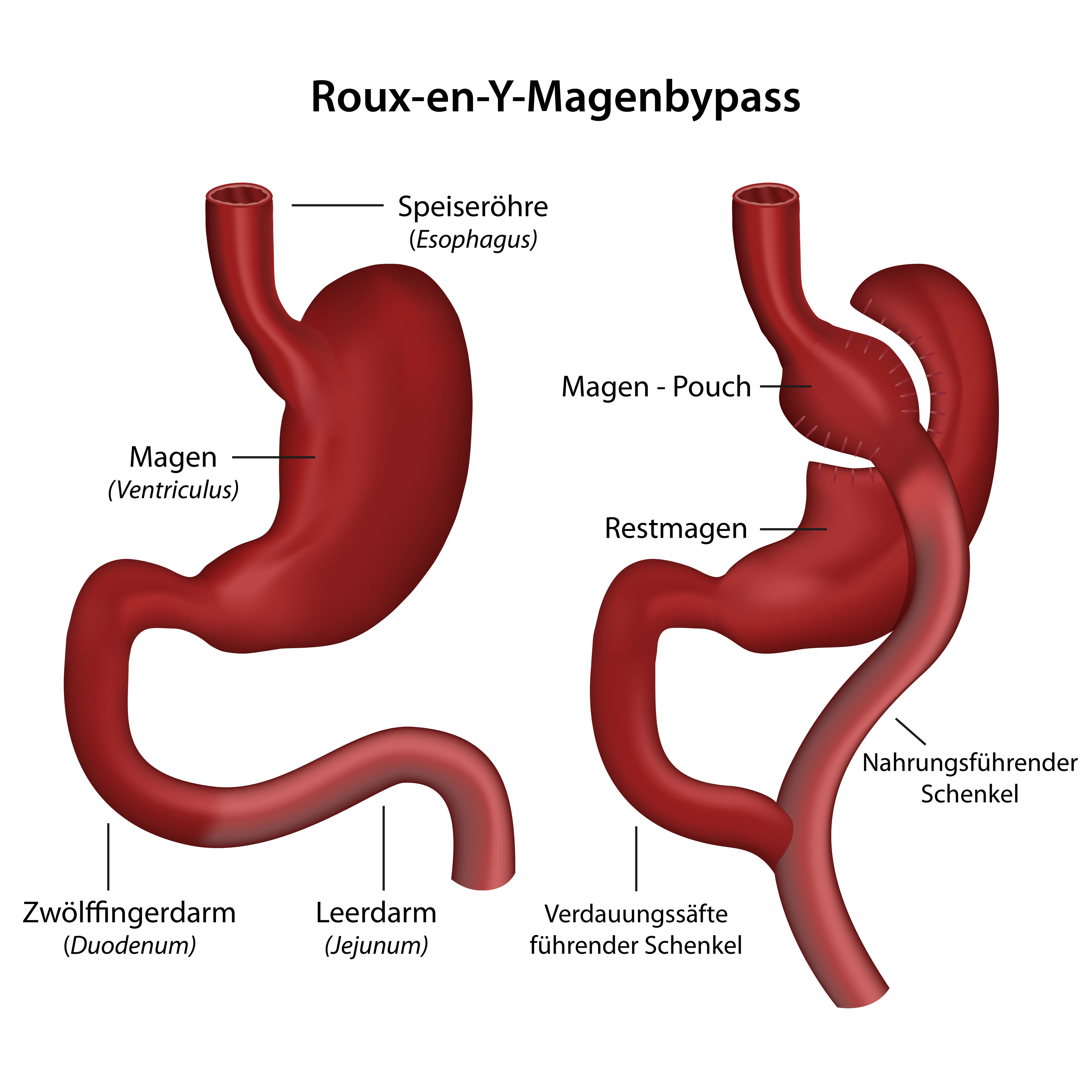 MagenOPs Suizidrisiko bei Patienten mit MagenBypass erhöht