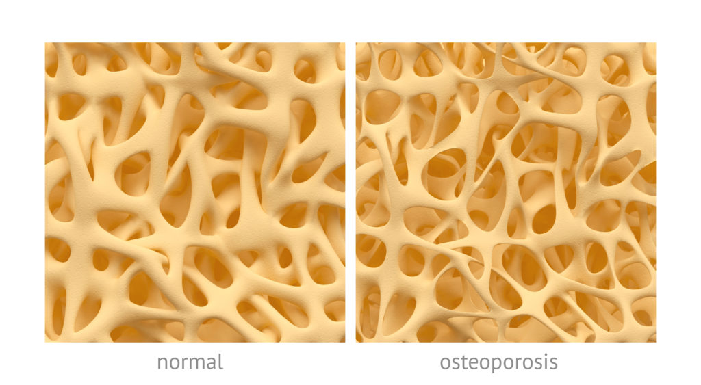 Bei Osteoporose ist die Knochdichte derart gering, dass leicht Frakturen auftreten können. (Bild: eranicle/fotolia.com)