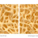 Bei Osteoporose ist die Knochdichte derart gering, dass leicht Frakturen auftreten können. (Bild: eranicle/fotolia.com)