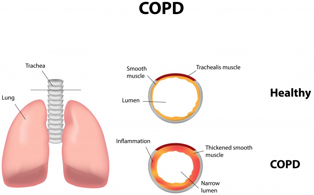 Raucherhusten im Zuge einer fortschreitenden COPD. Bild: joshya - fotolia