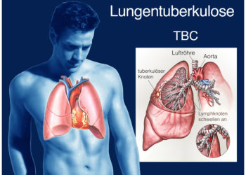 Laut WHO-Bericht erkranken noch immer viele Menschen an der Tuberkulose. Bild: Henrie - fotolia