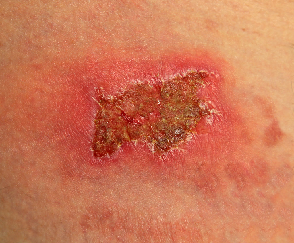 A large burn wound that has completely scabbed over.