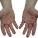 Hand-Fuss-Mund-Erkrankung. Bild: GordonGrand - fotolia