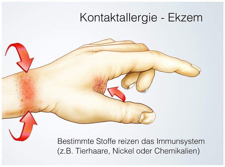 Nickelallergie: Hautrötungen, Jucken und Schmerzen. Bild: Henrie - fotolia