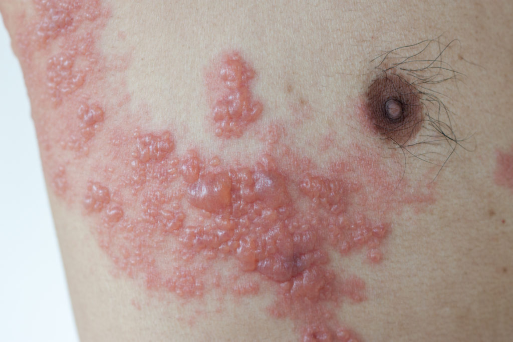 Herpes Zoster (Gürtelrose) führt zu einem erhöhten Herzinfarkt- und Schlafanfall-Risiko. (Bild: phadungsakphoto/fotolia.com)