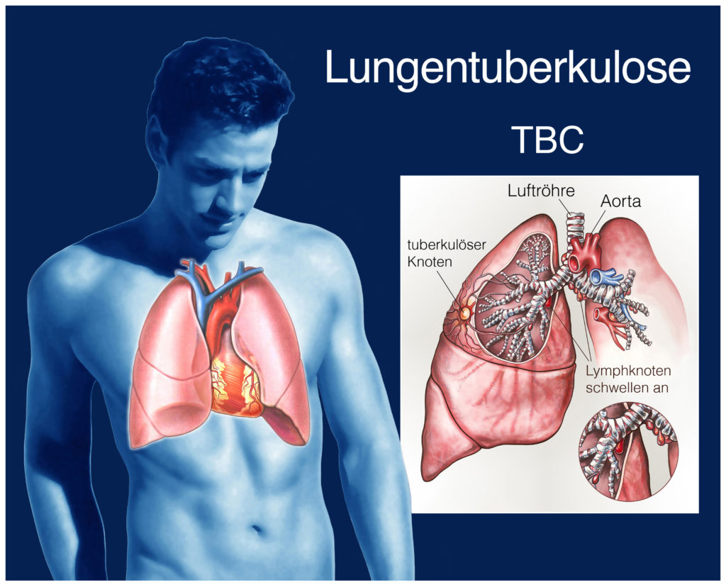 Die Zahl der Tuberkulose-Fälle ist im Jahr 2014 deutschlandweit um mehr als fünf Prozent gegenüber dem Vorjahr gestiegen. (Bild: Henrie/fotolia.com)
