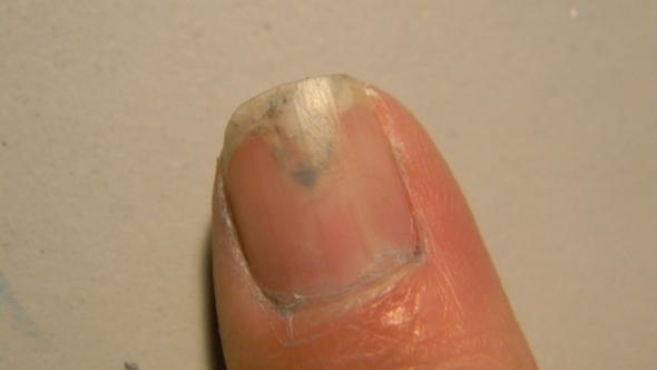 Einfache Diagnose Beschaffenheit Der Fingernagel Kann Auf Erkrankungen Hinweisen Heilpraxis
