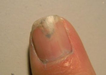 Nagelverfärbungen sind teils "nur" eine optische Beeinträchtigung, können aber auch auf andere Ursachen hindeuten. (Bild: fotolia.com)