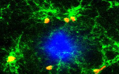 Die Entzündungsprozesse im Gehirn (grün erkennbare Mikrogliazellen) sind maßgeblich an der Entwicklung von Alzheimer beteiligt. (Bild: University of Southampton)