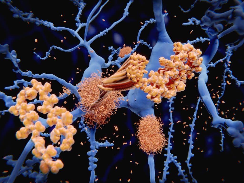 Ablagerungen im Gehirn, die im Zuge  einer Alzheimer-Krankheit entstehen.