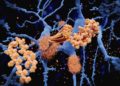 Ablagerungen im Gehirn, die im Zuge einer Alzheimer-Krankheit entstehen.