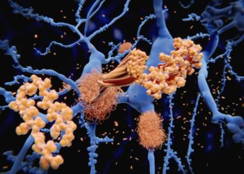 Ablagerungen im Gehirn, die im Zuge einer Alzheimer-Krankheit entstehen.