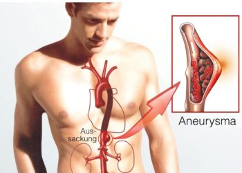 Schaubild Aneurysma
