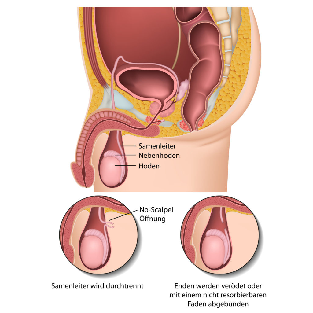 Bei der herkömmlichen Vasektomie werden die Samenleiter durchtrennt, mit den Ventil ließe sich die Verbindung verschließen. bliebe aber grundsätzlich erhalten. (Bild: bilderzwerg/fotolia.com) 