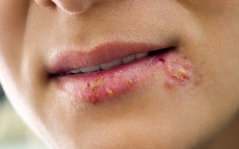 Herpes kann einen Herzinfarkt begünstigen. Bild: Cherries - fotolia