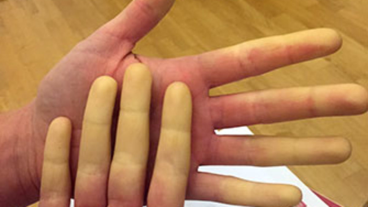 Weisse Finger Harmloses Symptom Oder Hinweis Auf Schwere Erkrankungen Heilpraxis