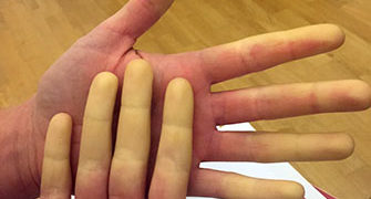 Die bleichen Finger bei Morbus Raynaud sind Folge einer Durchblutungsstörung und meist harmlos. (Bild: Medizinische Universität Wien)