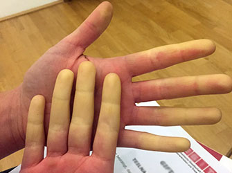 Die bleichen Finger bei Morbus Raynaud sind Folge einer Durchblutungsstörung und meist harmlos. (Bild: Medizinische Universität Wien)