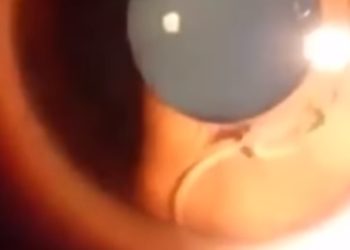 Schlimme Diagnose: Frau lebt mit Wurm im Auge. Bild: Screen-Youtube-Video