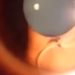 Schlimme Diagnose: Frau lebt mit Wurm im Auge. Bild: Screen-Youtube-Video