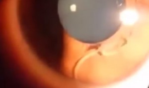 Schlimme Diagnose: Frau lebt mit Wurm im Auge. Bild: Screen-Youtube-Video