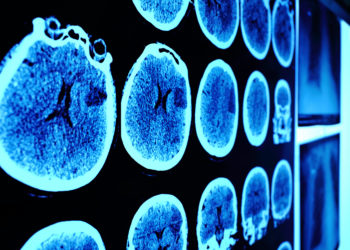 Bei der zukünftigen Behandlungen von Gehirntumoren könnten umgewandelte Hautzellen helfen. (Bild: sudok1/fotolia.com)