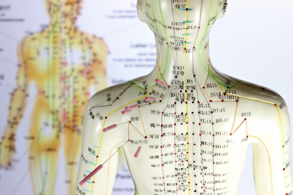 Akupunktur-Behandlungen haben sich bei vielen Krankheiten bewährt. Neueste Studien bestätigen nun auch die positive Wirkung bei Fibromyalgie. (Bild: Björn Wylezich/fotolia.com)