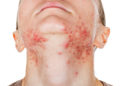 Hautausschlag im Gesicht ist für die Betroffenen oftmals auch mit psychischen Belastungen verbunden. (Bild: Ocskay Bence/stock.adobe.com)