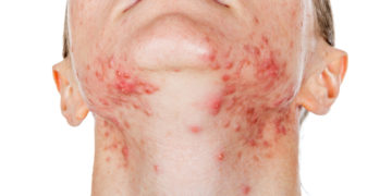 Hautausschlag im Gesicht ist für die Betroffenen oftmals auch mit psychischen Belastungen verbunden. (Bild: Ocskay Bence/stock.adobe.com)