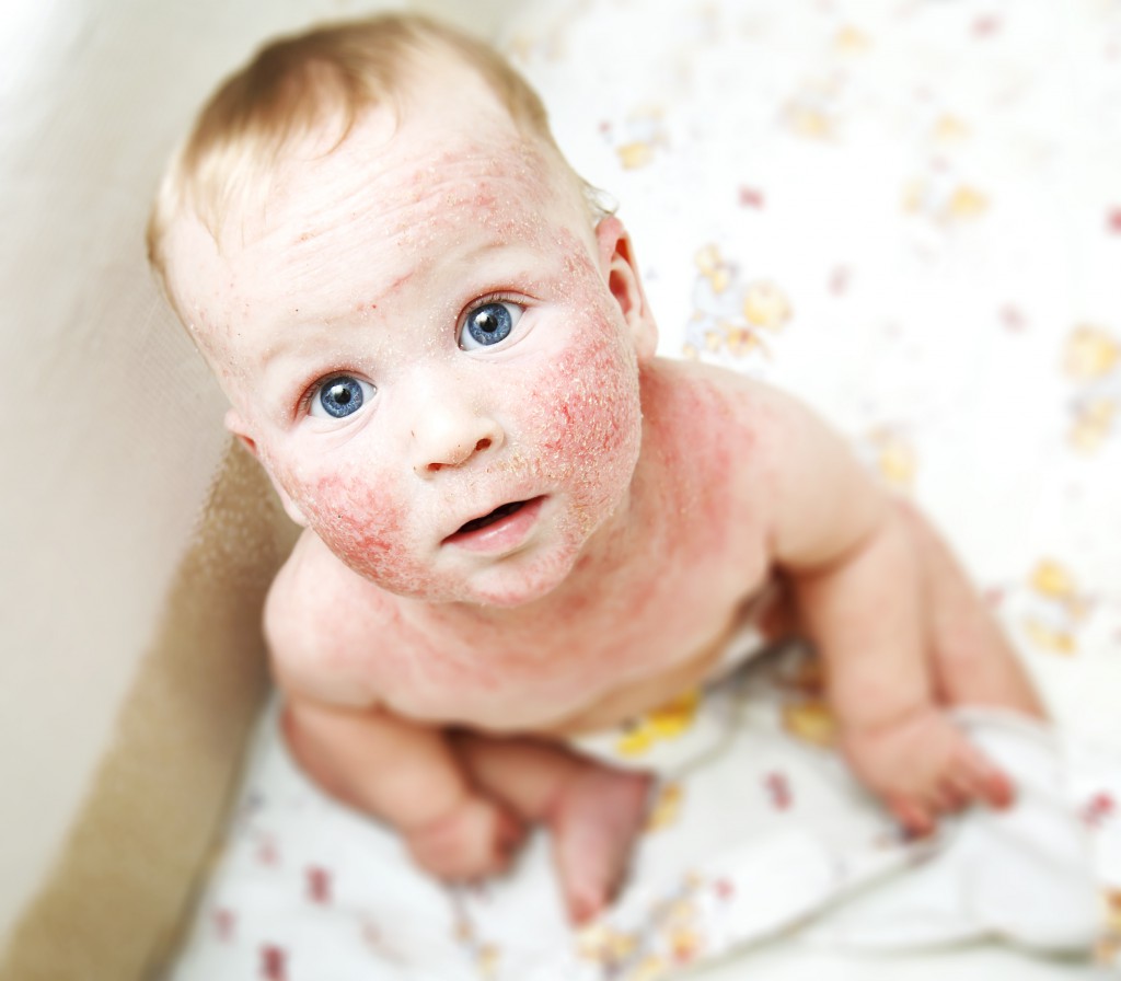 Little baby with dermatitis on face