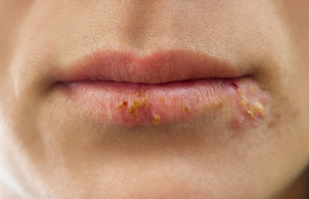 Eine der häufigsten Ursachen für Hautausschlag im Gesicht ist Herpes. (Bild: Cherries/fotolia.com)