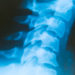 Ein neues Implantat hilft die Bewegungsabläufe nach einer Rückenmarksverletzung wieder herzustellen. (Bild: VRD/fotolia.com)