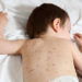 Windpocken zählen zu den häufigsten Kinderkrankheiten. Durch eine Impfung kann der Nachwuchs davor geschützt werden. (Bild: loflo/fotolia.com)