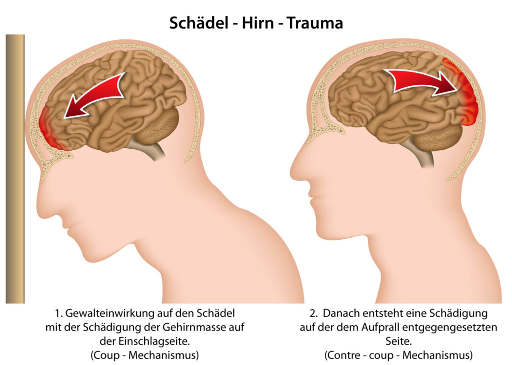 Erhöhtes Suizidrisiko durch Gehirnerschütterung. Bild: bilderzwerg - fotolia