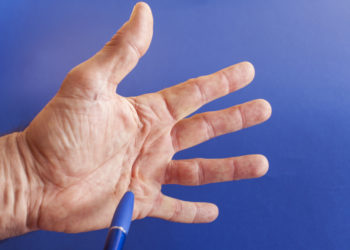 Geplatzte Ader auf der Hand. (Bild: perfectmatch/stock.adobe.com)