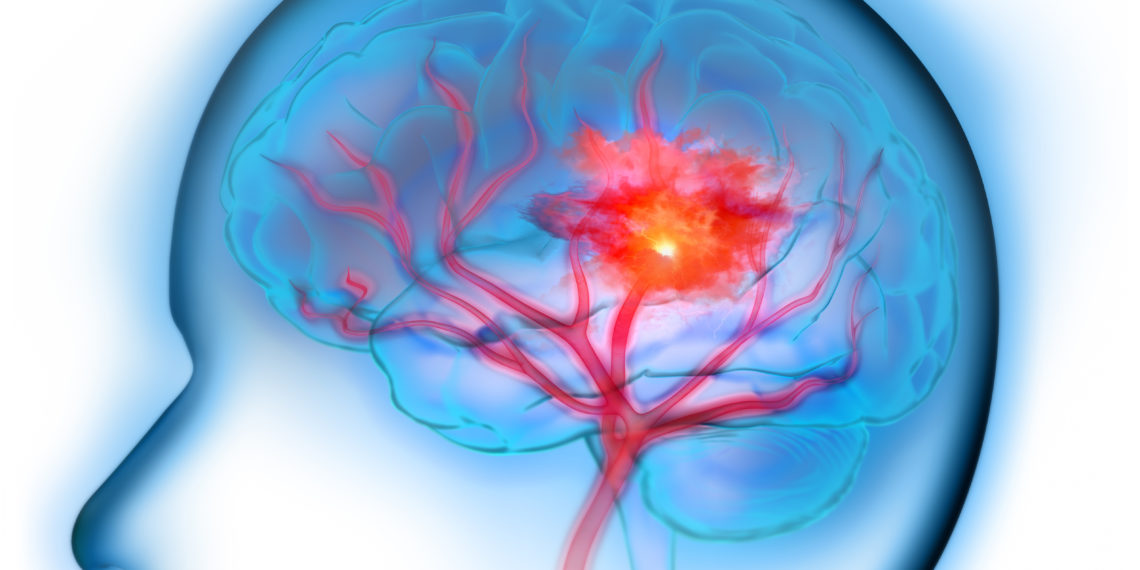 Hirninfarkt Durch Embolie Zerebraler Arterien www.heilpraxisnet.de