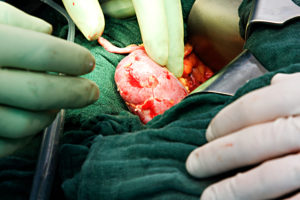 Revolutionäre Methode ermöglicht es Patienten, eine transplantierte Niere von einem eigentlich inkompatiblen Spender zu erhalten.(Bild: horizont21/Fotolia.com) 