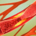 Arteriosklerose: Cholesterin ist eine Ursache hierfür. Bild: Christoph Burgstedt - fotolia