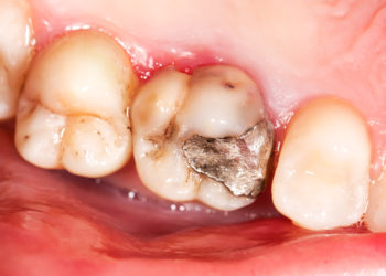Amalgam-Füllung: Viele Patienten fühlen eine Art Allergie. Restlos aufgeklärt ist dieses Phänomen noch nicht. Bild: Zsolt Bota Finna - fotolia