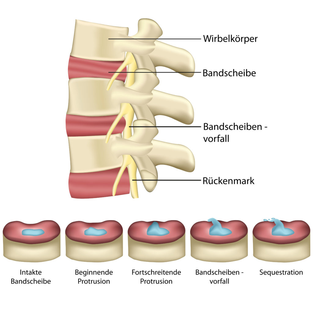 Das passiert bei einem Bandscheibenvorfall. Bild: Bilderzwerg - fotolia