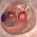 Bei einer Darmspiegelung entdeckt >Polypen werden entfernt, damit aus ihnen kein Darmkrebs entsteht. Doch dabei kann es zu Verletzungen der Darmwand kommen. (Bild: Alex/fotolia.com)