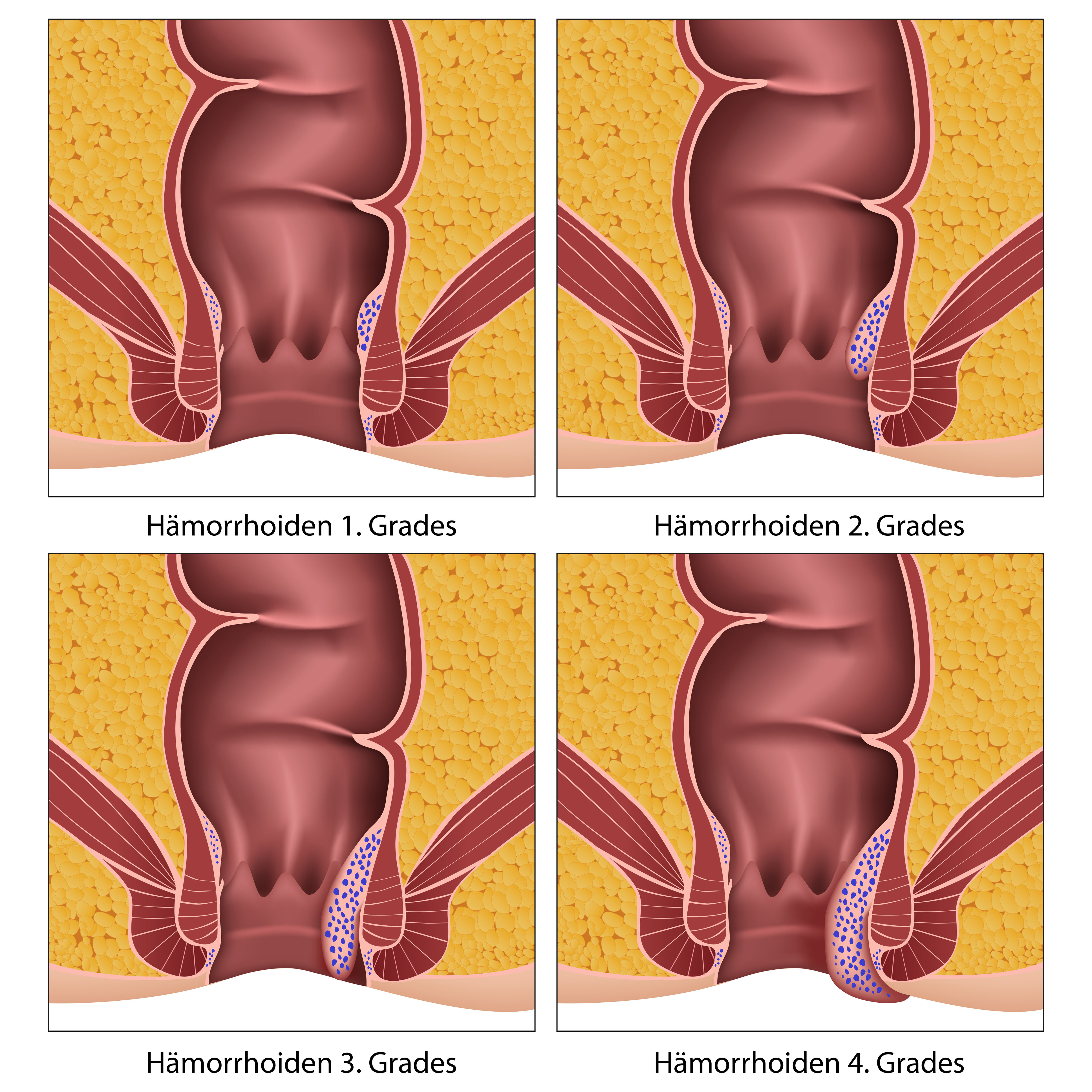 HämorrhoidenPolster schwellen an Zeitnahe Therapie wichtig Heilpraxis