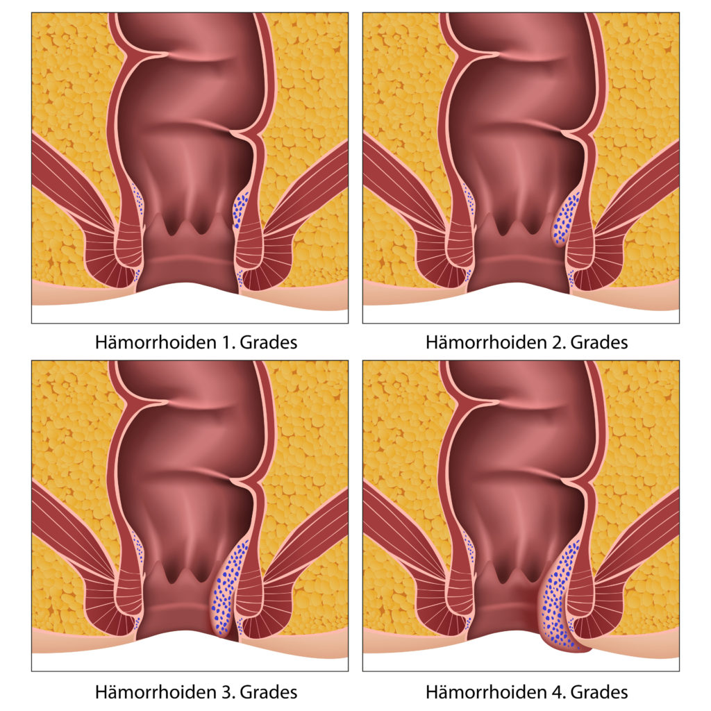 Häufig Ursache für Blutungen am After sind Hämorrhoiden. (Bild: bilderzwerg/fotolia.com)