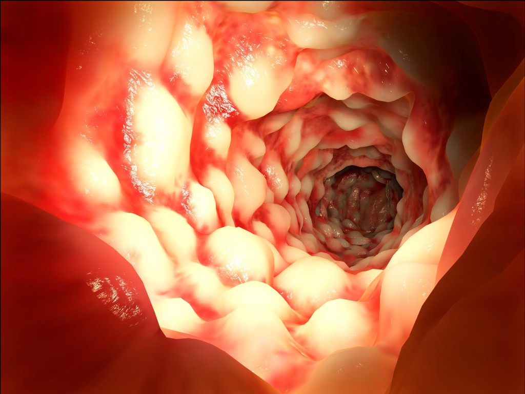 Bei chronisch entzündlichen Darmerkrankungen wie Morbus Crohn sind infolge der Gewebeschädigung mitunter Blutbeimengungen  im Stuhl und Blut am After festzustellen (Bild: Juan Gärtner/fotolia.com)